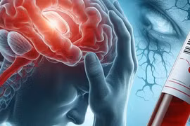 Xét nghiệm máu đột phá giúp dự đoán trước đột quỵ