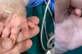 Phẫu thuật tạo hình cho bé gái có 24 ngón tay chân, bị dư ngón, dính ngón