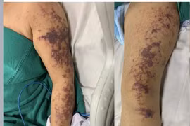 Một phụ nữ mắc liên cầu lợn tình trạng nguy kịch sau khi ăn lòng