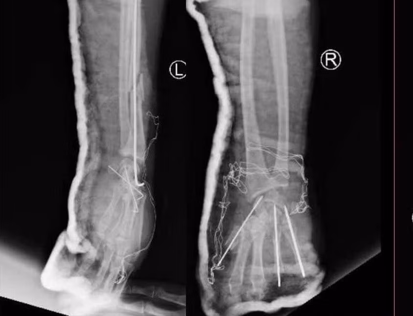 Vết thương bàn tay trái và phải sau phẫu thuật trên phim X-quang. Ảnh: BVCC