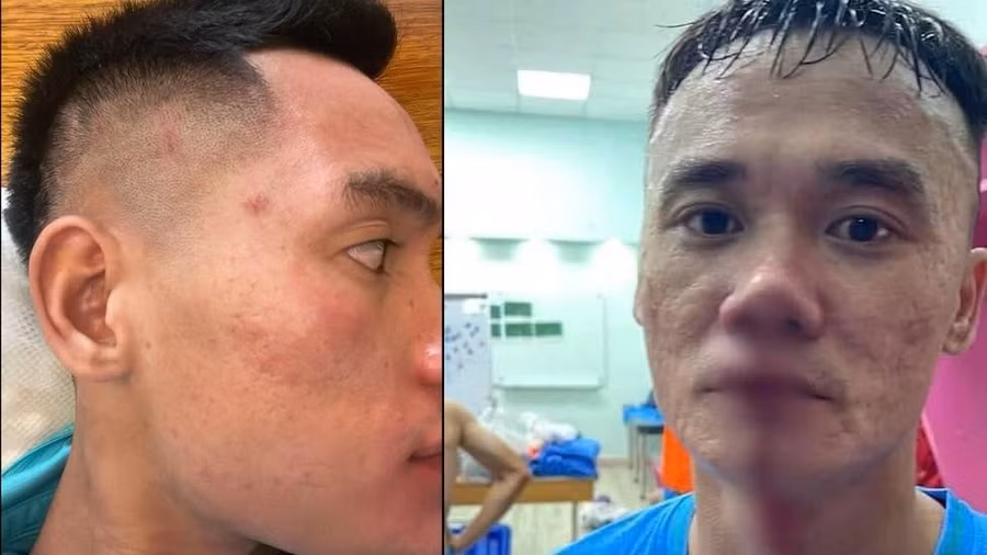 Văn Sơn và Xuân Nam (phải) sau vụ xô xát