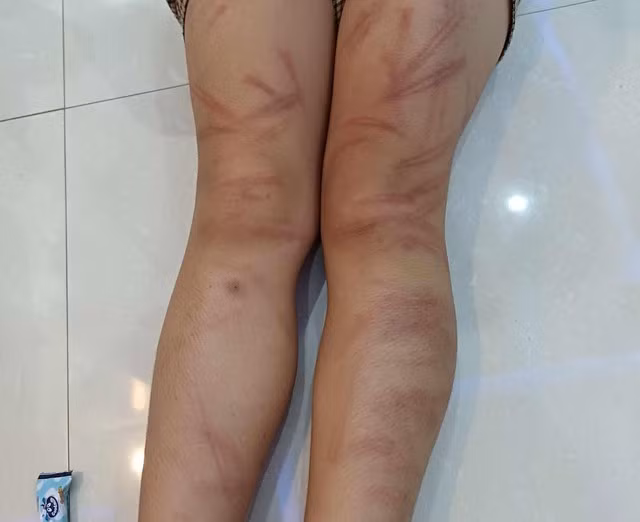 Một em học sinh bị đánh bầm tím cả 2 chân