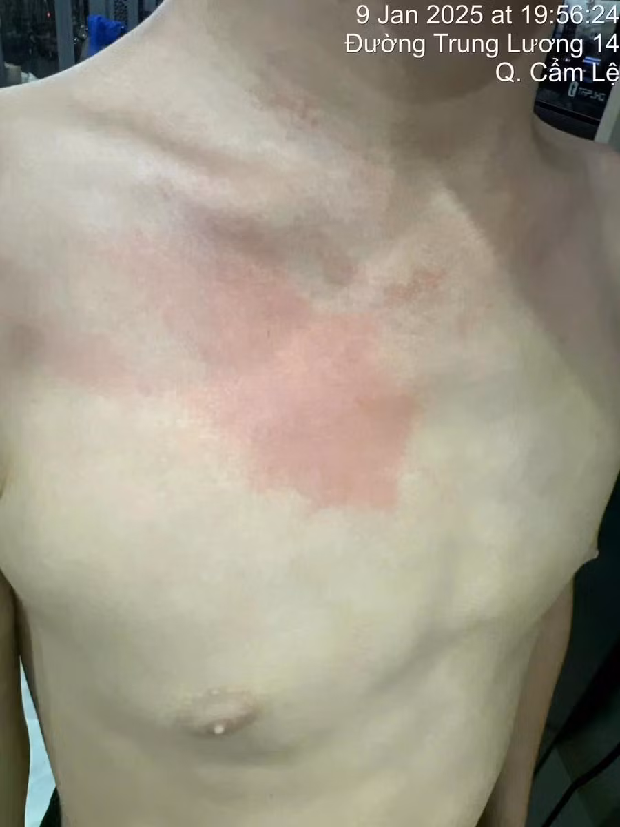 Vết đỏ trên ngực em M., được gia đình cho là do HLV CLB taekwondo gây ra