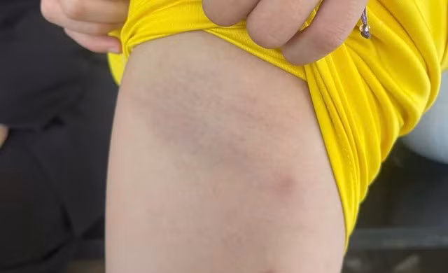 Cô giáo dùng vỏ dây điện đánh bầm tím đùi học sinh lớp 5