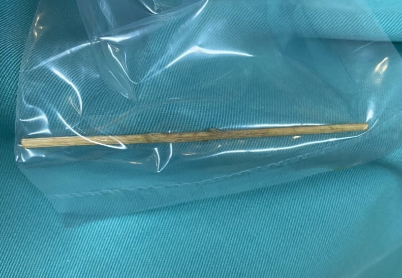 Cây tăm nhọn dài 7cm nằm trong bụng bệnh nhi Cây tăm nhọn dài 7cm nằm trong bụng bệnh nhi