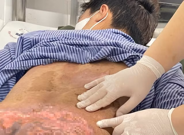 Nam bệnh nhân nhập viện trong tình trạng nhiều vùng da bị tổn thương nghiêm trọng