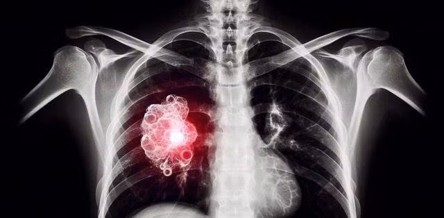 Khi thử nghiệm loại vắc xin mới này cho 4 loại ung thư, gồm ung thư phổi, ung thư buồng trứng, ung thư da và ung thư vú, kết quả cho thấy vắc xin đã tạo ra phản ứng mạnh mẽ của các tế bào T gây độc, tấn công các khối u đang phát triển, ngăn chặn sự phát triển và di căn thêm của chúng