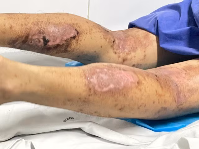 Vùng da chân bệnh nhân bị kích ứng sau khi bôi "thuốc" chế từ kiến ba khoang