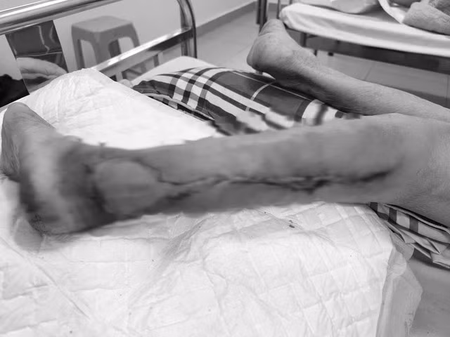 Bệnh nhân được phẫu thuật tạo hình tổ chức viêm và vùng da tổn thương