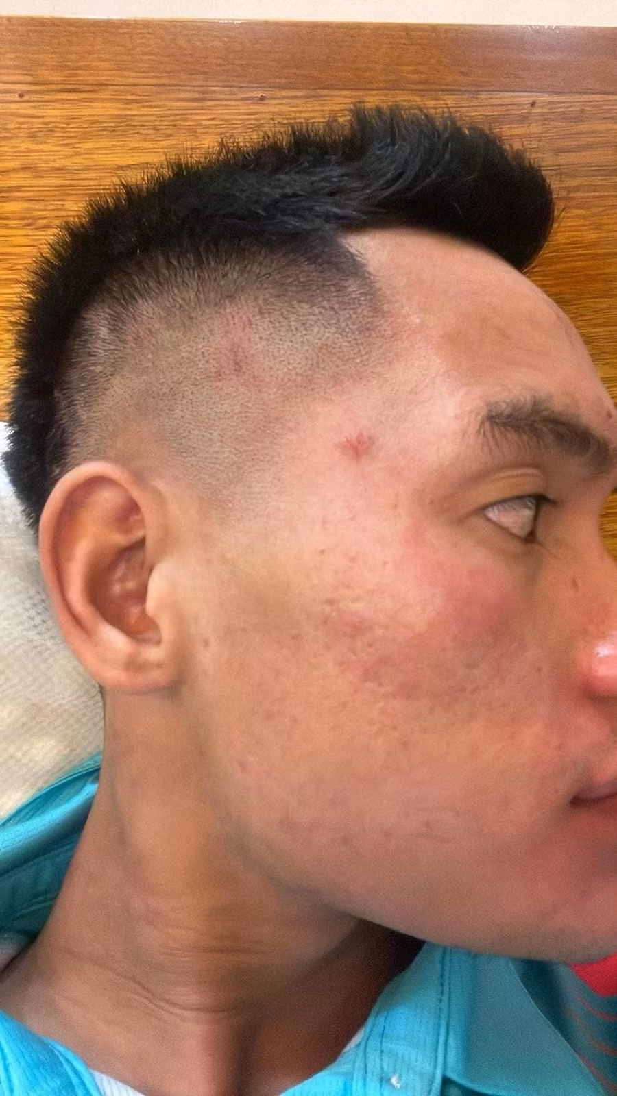 Mặt Văn Sơn tấy đỏ