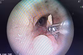 Hy hữu: Hóc xương vịt trong phế quản 2 năm mới gắp ra