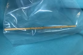 Gắp cây tăm nhọn dài 7cm nằm trong bụng bệnh nhi