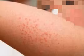 Hà Nội: Bé gái tử vong do mắc sởi