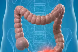 Ứng dụng AI xác định ung thư đại tràng từ phân tích mẫu mô bệnh học