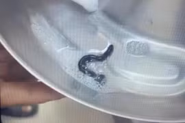 Phát hiện đỉa trong đường thở của bệnh nhi 5 tuổi ở tỉnh Đắk Lắk