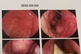 Gia Lai: Một thanh niên có răng mọc ở… hốc mũi