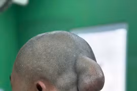 Bệnh viện Đại học Y Dược-Hoàng Anh Gia Lai cắt bỏ thành công khối u lạ 30 năm treo trên đầu bệnh nhân