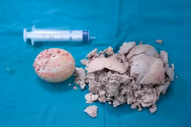 Bệnh viện Hùng Vương Gia Lai phẫu thuật lấy viên sỏi bàng quang “khổng lồ” 