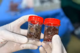 Gia Lai: Phẫu thuật nội soi cắt thận, lấy hơn 100 viên sỏi trong thận người bệnh