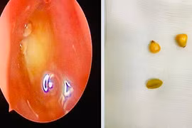 Cảnh báo tình trạng trẻ nhỏ nhét dị vật vào mũi