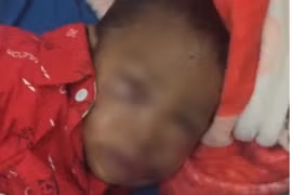 Bé trai 2 tuổi ở xã Ia Krái bị chó thả rông tấn công vùng mặt