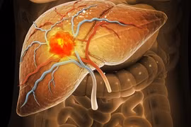 Số ca mắc loại ung thư 'sát thủ' có thể tăng gấp đôi vào năm 2050