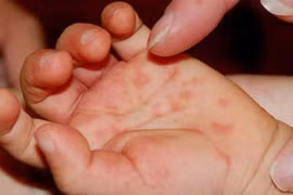 Bộ Y tế chỉ đạo tăng cường công tác phòng-chống bệnh tay chân miệng