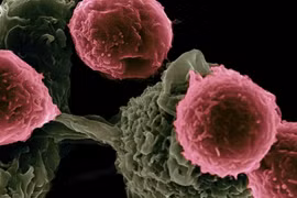Australia phát triển liệu pháp miễn dịch mới cho ung thư máu hiếm gặp