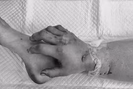 Thai phụ được ghép tạm bàn tay đứt lìa vào chân