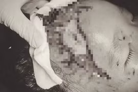 Bé trai 2 tuổi bị chó cắn lộ xương sọ khi sang nhà người thân chơi