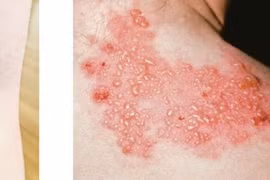 Báo động bệnh viêm não hiếm gặp tăng bất thường