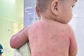 Bé trai 2 tuổi bị bỏng 60% được cứu sống nhờ ghép da từ mẹ