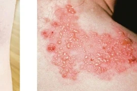 Báo động bệnh viêm não hiếm gặp tăng bất thường