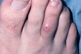 Mexico xác nhận trường hợp đầu tiên mắc bệnh giòi 'ăn thịt' ở người