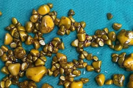 Người phụ nữ 'giấu cả trăm cục vàng' trong... túi mật