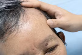 Người đàn ông ở Đà Nẵng bị ong đốt đến hôn mê, suýt chết