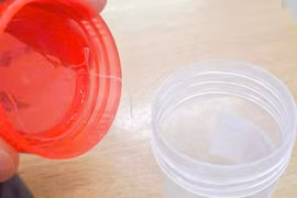 Ký sinh trùng 10 cm sống trong mắt bệnh nhân