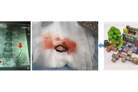 Ớn lạnh phát hiện 20 viên nam châm rỉ sét nằm trong bụng bé trai