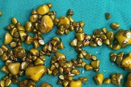 Người phụ nữ 'giấu cả trăm cục vàng' trong... túi mật