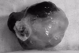 Cô gái trẻ suýt đột tử vì khối u 'ẩn mình' trong tim