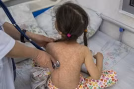 Dịch sởi bùng phát, Bolivia tuyên bố tình trạng khẩn cấp quốc gia