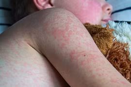 Những sai lầm nguy hiểm của cha mẹ khi chăm sóc con bị sởi khiến bệnh nặng thêm