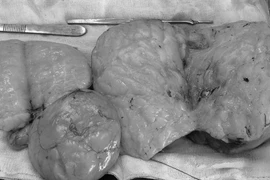 3 khối bướu mỡ nặng 1,5 kg được lấy ra khỏi cơ thể người phụ nữ