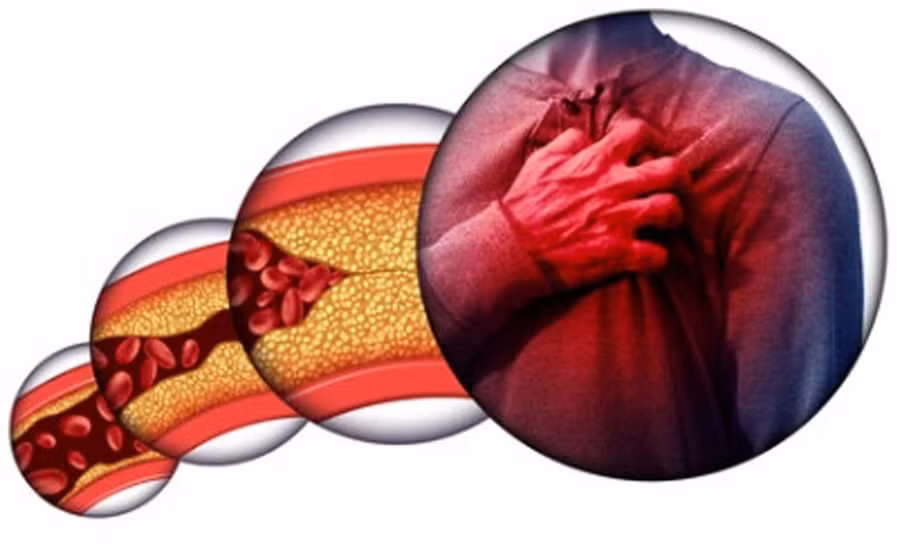 Quá nhiều cholesterol trong máu, theo thời gian, có thể tích tụ, gây tắc nghẽn động mạch. Ảnh: Shutterstock Quá nhiều cholesterol trong máu, theo thời gian, có thể tích tụ, gây tắc nghẽn động mạch. Ảnh: Shutterstock