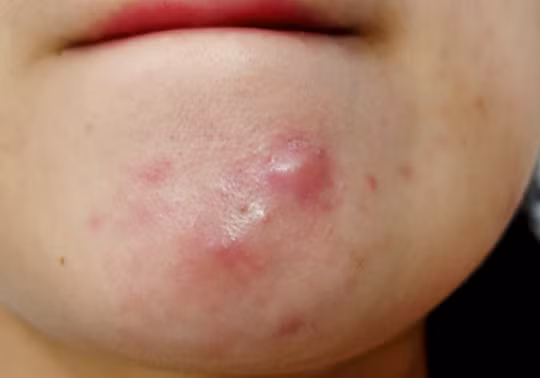 Thời tiết nồm ẩm là nguyên nhân gia tăng các bệnh da
