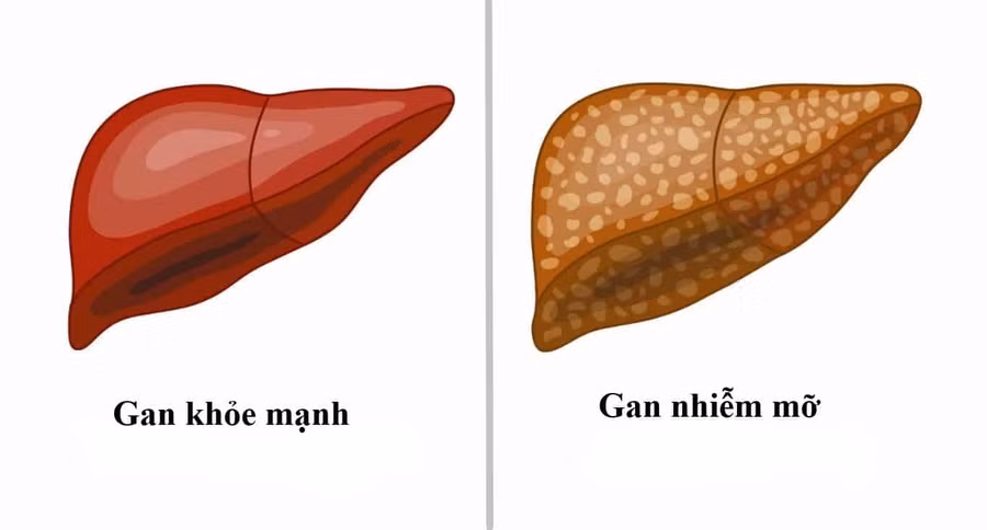 gan-nhiem-mo.jpg