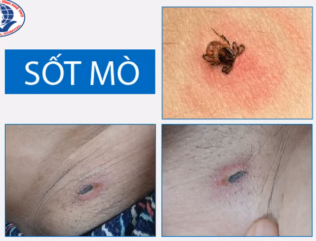 Hình ảnh nốt mò điển hình của bệnh sốt mò Hình ảnh nốt mò điển hình của bệnh sốt mò
