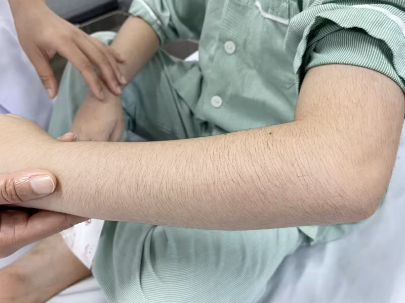 Biểu hiện của hội chứng Cushing là lông tay, chân mọc rậm Biểu hiện của hội chứng Cushing là lông tay, chân mọc rậm