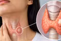 Người trẻ cũng mắc ung thư tuyến giáp: 4 yếu tố nguy cơ cần biết