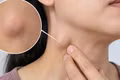 3 điều cần biết khi xuất hiện hạch ở cổ